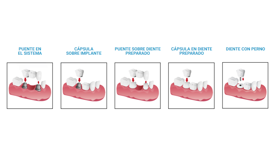PONTEFIX 1 KIT - FIJA PUENTES Y CAPSULAS DENTALES - Imagen 2